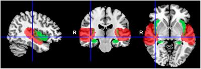 Functional changes in the auditory cortex and associated regions caused by different acoustic stimuli in patients with presbycusis and tinnitus